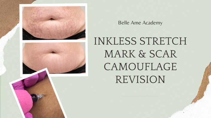 Ink-less Camouflage For Stretch Mark And Scar Camouflage
