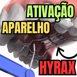 Imagem de capa para o Ebook PDF - Como deve ser feita a ativação do aparelho Hyrax e o que esse aparelho gera na maxila - Aula 165