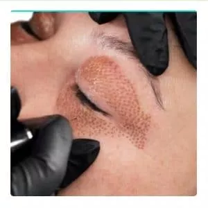 Imagen de portada para Curso online Curso de Certificación en Fibroblast / Plasma Pen