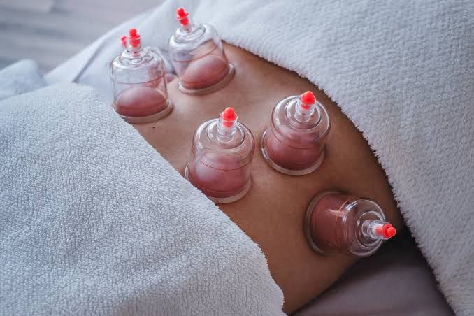 Imagem do curso Curso Ventosaterapia, Liberação Miofascial