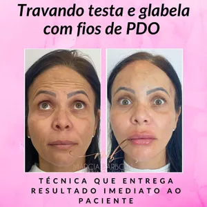 Imagem de capa para o Curso online Travando testa e glabela com fios de PDO