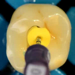 Imagem de capa para o Curso online Endolovers Originals - Controle de Dor em Endodontia
