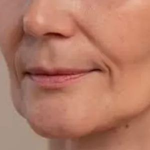 Imagen de portada para Curso online Relleno de surcos Nasogenianos