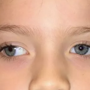 Imagem de capa para o Ebook Estrabismo - olho torto  ou  vesgo