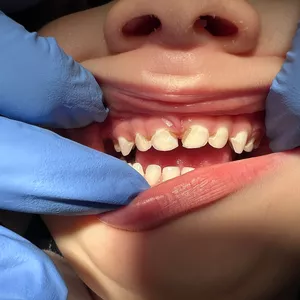 Imagem de capa para o Evento online Odontologia preventiva na primeira Infância
