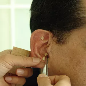 Imagem de capa para o Curso online Tratamento de Dor de Cabeça e Ansiedade em Casa Com Acupuntura