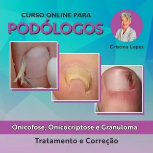 Imagem do curso Onicofose, Onicocriptose e Granuloma - Tratamento e Correção