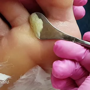 Curso 👣 Curso de Plástica e Spá dos Pés - Remova Calos e Rachaduras