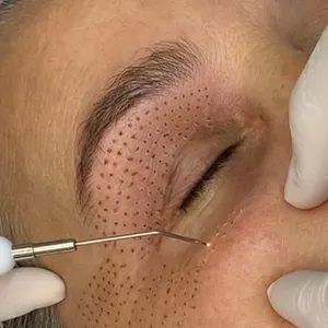 Imagem de capa para o Curso online Curso jato de plasma, eletrocautério e peeling elétrico on-line