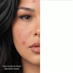 Imagem de capa para o Ebook Protocolos Especializados em Tratamento de Pele com Acne