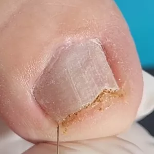 Imagem de capa para o Curso online Jato de Plasma e Eletrocautério na Podologia