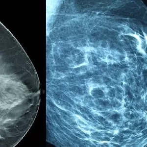 Imagem do curso TOMOSSINTESE E AVANÇOS TECNOLÓGICOS EM MAMOGRAFIA