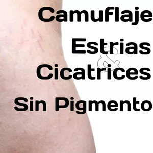 Imagen de portada para Curso online Curso de camuflaje de Estrías y Cicatrices sin uso de Pigmentos.