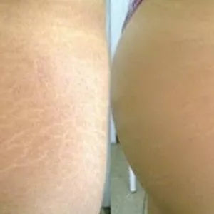 Cover image for Ebook Discover the homemade method capable of eliminating 90% of all types of stretch marks
