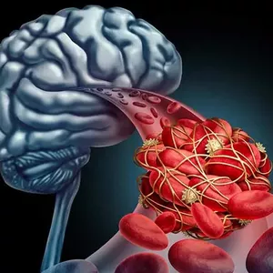 Imagen de portada para Ebook EVENTO CEREBROVASCULAR ISQUEMICO