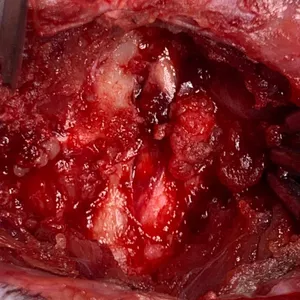 Imagem de capa para o Curso online Aspectos clínicos, diagnósticos e cirúrgicos das mielopatias compressivas + CANSORT-SCI