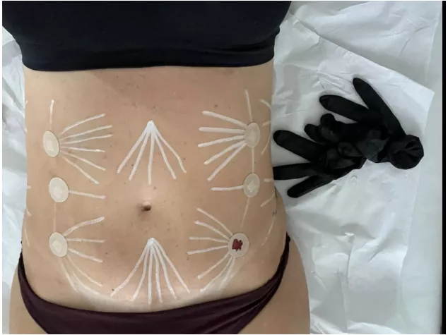 Expert em Endolaser Facial e Corporal Completo com Técnicas Avançadas  — imagem 3