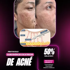 Imagen de portada para Curso online Subcisión Para Cicatrices de Acné