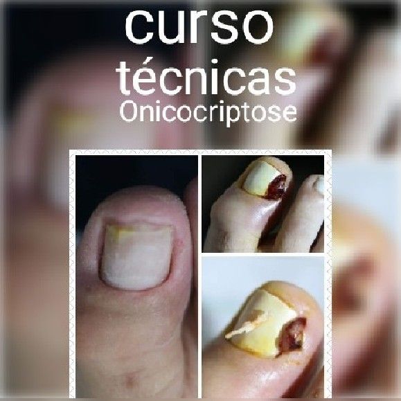 Curso Curso de Técnicas  de Onicocriptose/Unha Encravada 