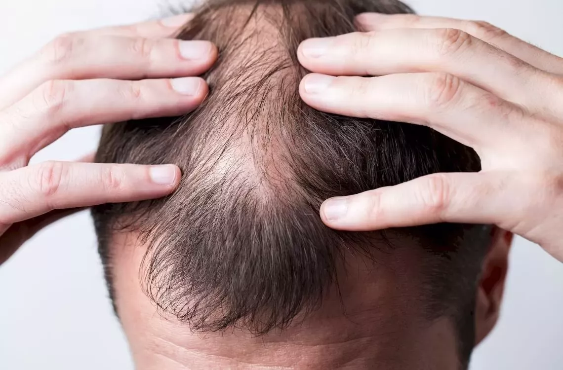 COMO FREAR A CALVÍCE - Dicas e Estratégias para manter o seu cabelo.