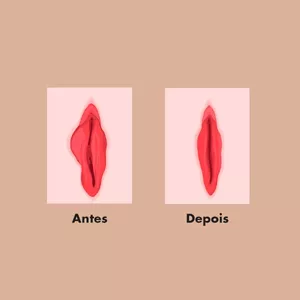 Imagem de capa para o Curso online Labioplastia Estética