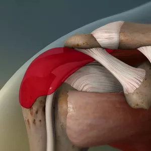 Imagem de capa para o Ebook BURSITE  - Causas e Consequências  -  Parte I