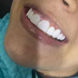 Imagem de capa para o Curso online Facetas em resina