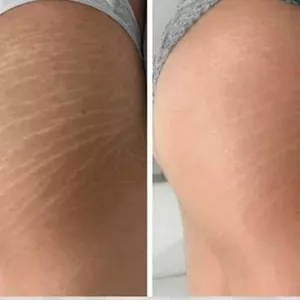 Imagen de portada para Curso online Elimina el 90% de tus estrías en 14 días