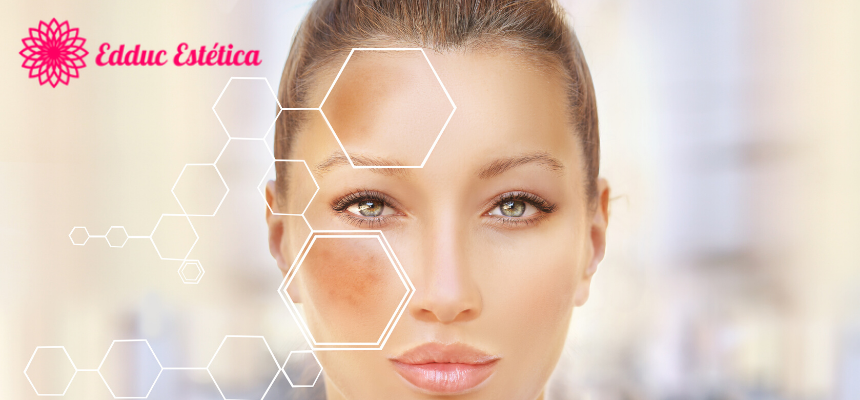 Tudo Sobre Melasma
