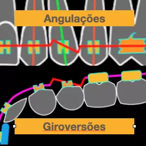 Imagem de capa para o Ebook E-Book DUPLO: Como Confeccionar uma Dobra em Z em apenas 7 Passos - Partes I e II - Correção da Angulação Mésio-Distal e Das Giroversões