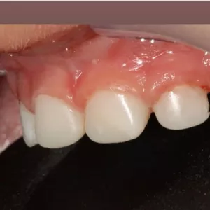 Imagem de capa para o Curso online Coroas de acetato em dentes decíduos: do zero à cimentação 