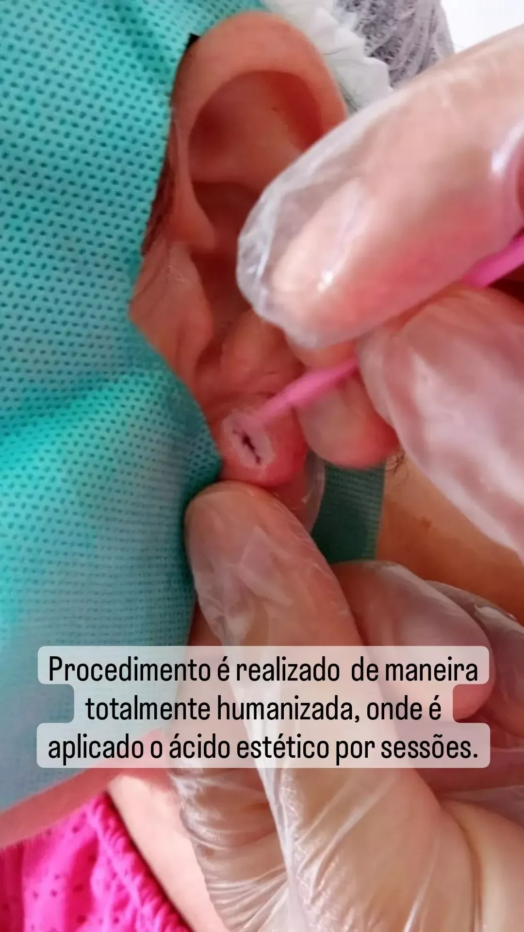 Curso de Lobuloplastia - Guia Completo para uma Reconstrução de Orelhas Rasgadas" — imagem 4