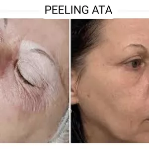 Imagem de capa para o Curso online Peeling ATA- Ácido tricloroacético