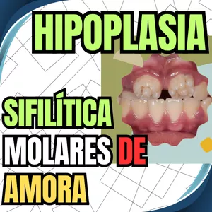 Imagem de capa para o Ebook PDF - MOLARES em formato de AMORA e incisivos de HUTCHINSON Hipoplasia SIFILÍTICA - Aula 46