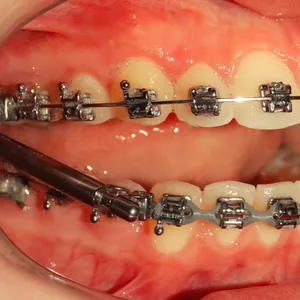 Imagem de capa para o Ebook Protrator Mandibular: Quais as indicações, Passo a Passo de instalação e protocolo de uso.