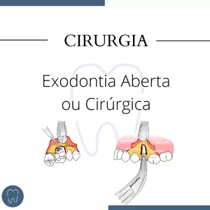 Imagem de capa para o Ebook Exodontia Aberta - Souza Bru