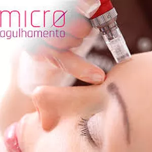 Imagem de capa para o Curso online Curso de Microagulhamento