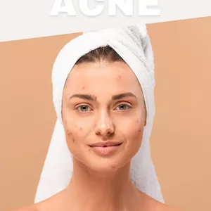 Imagem de capa para o Ebook End of Acne