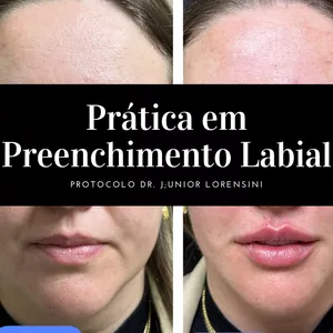 Imagem de capa para o Curso online Prática em Preenchimento Labial Protocolo Dr. Júnior Lorensini