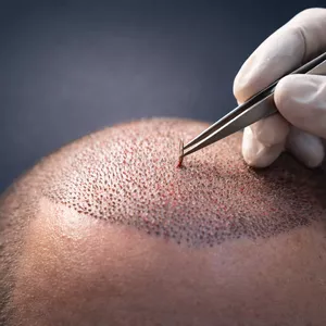 Imagem do curso Dominando Transplante Capilar: Curso Completo de Técnica FUE para Médicos