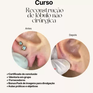Imagem do curso Reconstrução de Lóbulo não Cirúrgica 