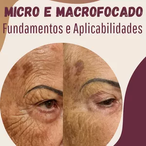 Imagem de capa para o Ebook EBOOK - ULTRASSOM MICRO E MACROFOCADO: FUNDAMENTOS E APLICABILIDADES