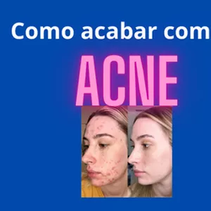 Imagem de capa para o Ebook Acabe com o Acne