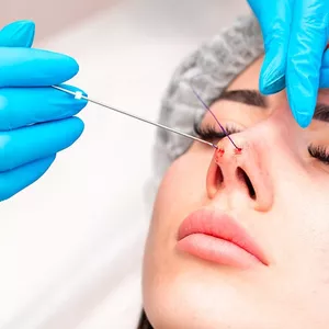 Imagem de capa para o Curso online Rinomodelação com Fios de PDO