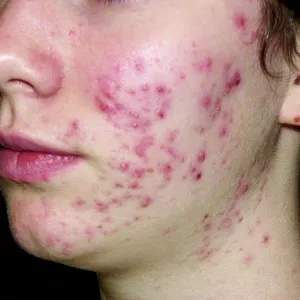 Imagem de capa para o Curso online PELE FÊNIX