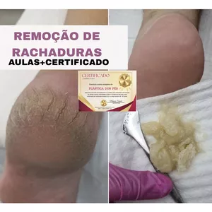 Imagem do curso Plástica dos pés, remoção das rachaduras dos pés, calosidades 
