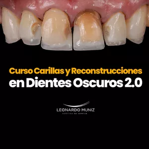 Imagem de capa para o Curso online Carillas y reconstrucciones en dientes oscuros 2.0