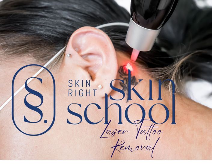 Laser Tattoo Removal