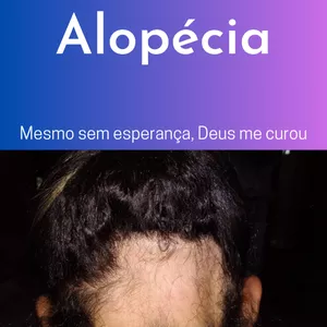 Imagem de capa para o Ebook Minha Alopécia