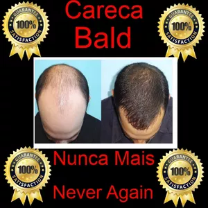 Imagem de capa para o Ebook Careca Nunca Mais.  Bald Never Again